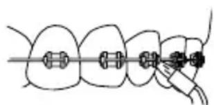 Waterpik WP674 - Embout orthodontique - 2