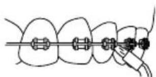 Waterpik WP674 - Orthodontic Tip - 1