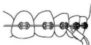 Waterpik WP672 - Embout orthodontique - 2