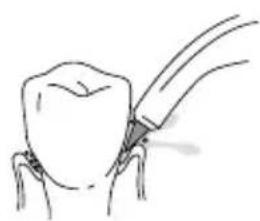 Waterpik WP670 - GEBRUIK VAN DE TIP Pik Pocket® Tip - 1