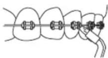 Waterpik WF03 - Orthodontic-Düse - 1