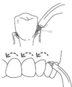 Waterpik WF03 - Zungenreiniger-Aufsatz - 1