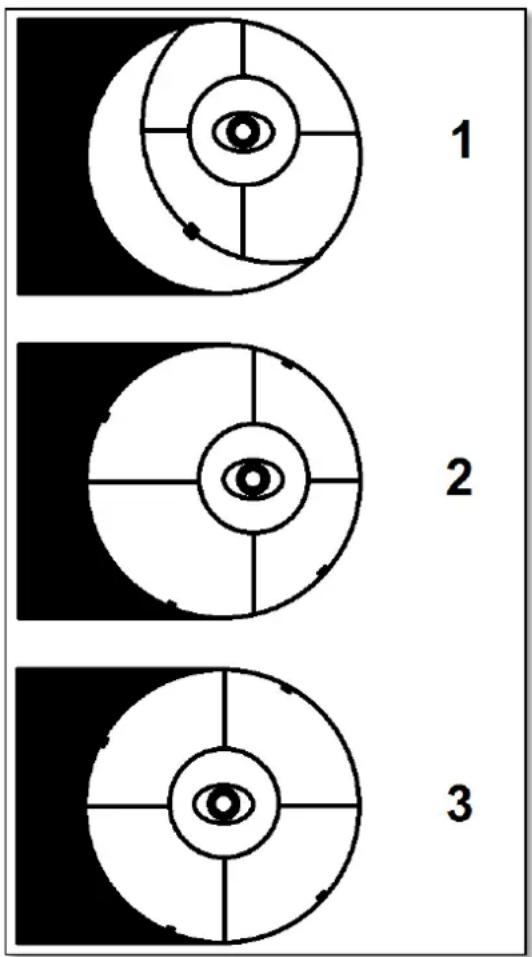 Omegon 150750 EQ4 - Collimation de l'optique. - 1