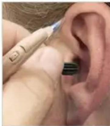 Starkey DaVinci - INSERTION - 2
