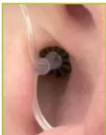 Starkey Aspect Extra - INSERTION - 2