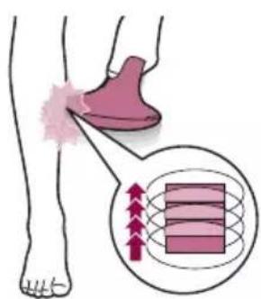 PHILIPS Lumea Advanced BRI920 - Dos发展模式 de tratamiento: "Paso y pulso" "deslizamente y pulso" - 2