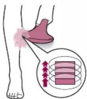 PHILIPS Lumea Advanced BRI920 - Zwei Behandlungsmodi: „Halten + Lichtimpuls" und „Gleiten + Lichtimpuls" - 2