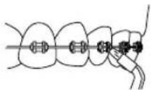 Waterpik WP562E - Orthodontic Tip - 4