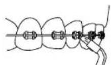 Waterpik WP560E - Orthodontic Tip - 5