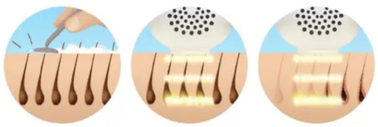 HOMEDICS Duo Salon - Préparer la zone a traiter - 1