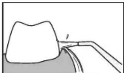 PANASONIC EWDJ10 - Pour les dents du bas - 1