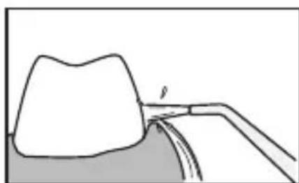 PANASONIC EWDJ10 - Tilde nedre tander - 1