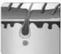 SANITAS IPL 80 - IPL technology – how it works - 2