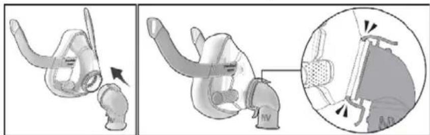 ResMed NV Elbow F20 - การประกอบชิ้นส่วนหน้ากาก - 1