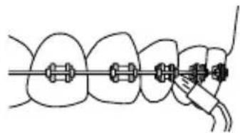 Waterpik WP950 - Orthodontic Tip - 1