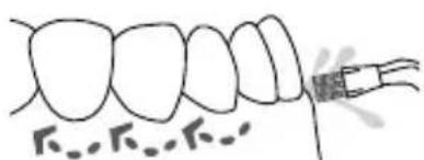 Waterpik WP950 - Embout orthodontique - 1