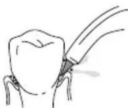 Waterpik WP950 - Embout Pik Pocket MC - 1