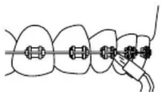 Waterpik WP950 - Orthodontic-Düse - 1