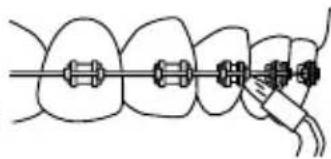 Waterpik WP950 - Orthodontische Tip - 1