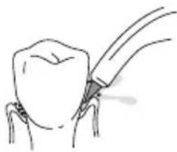 Waterpik Ultra WP112E1 - Pik Pocket® Tip - 1