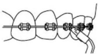 Waterpik Ultra WP112E1 - Orthodontische Tip - 3