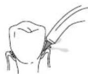 Waterpik WP462E1 - Beccuccio ortodontico - 1