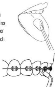 Waterpik WP462E1 - Orthodontic-Düse - 3