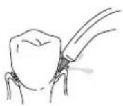 Waterpik WP462E1 - Orthodontic-Düse - 1