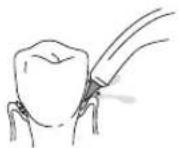 Waterpik WP462E1 - UTILISATION DE L'EMBOUT Embout Pik Pocket - 1