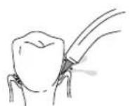 Waterpik WP462E1 - Orthodontic Tip - 1