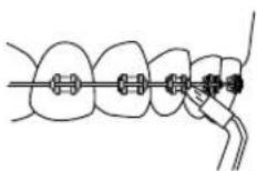 Waterpik WP462E1 - Orthodontische tip - 4