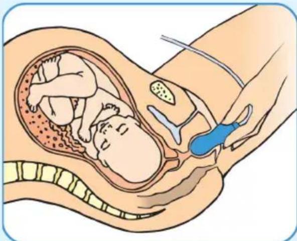 Epi-no Delphine Plus - Exercise the Pelvic Floor Muscles - 1