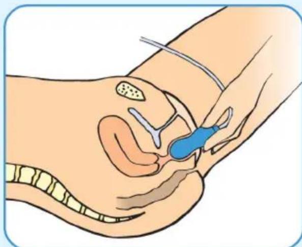 Epi-no Delphine Plus - Perineal Draw Up Exercise - 1