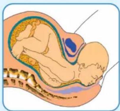 Epi-no Delphine Plus - EPI·NO-Birth Preparation - 2