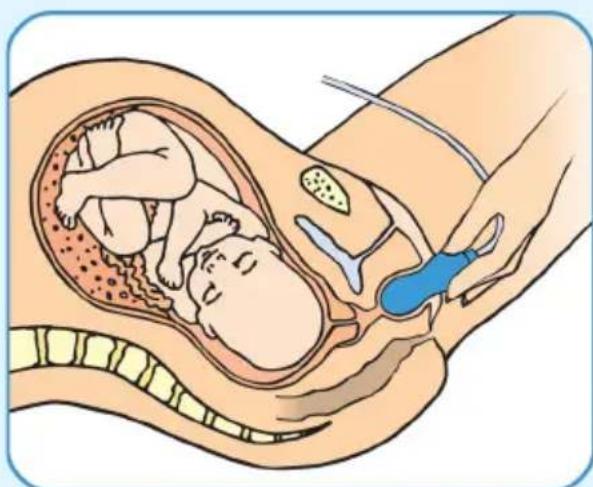 Epi-no Delphine Plus - Préparation à l'accouchement en 3 phases - 1