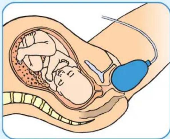 Epi-no Delphine Plus - Bleiben Sie aber immer unterhalb ihrer personlichen Schmerzgrenze. - 1