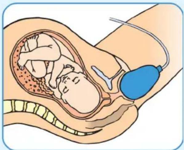 Epi-no Delphine Plus - Stretch the Perineum - 1