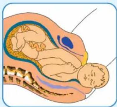 Epi-no Delphine Plus - Précautions - 3