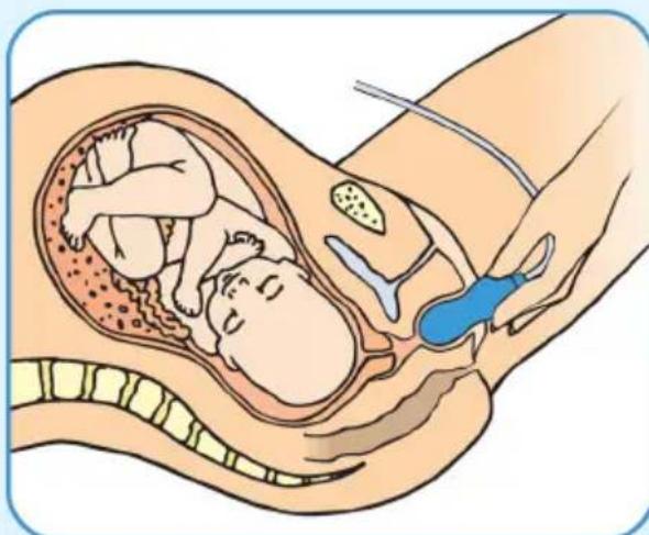 Epi-no Delphine Plus - Programa de tres fases de preparación al parto - 1