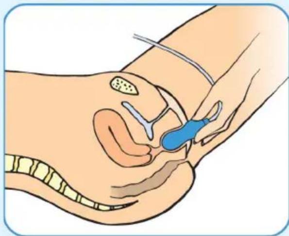 Epi-no Delphine Plus - Inizio degli esercizi - 1