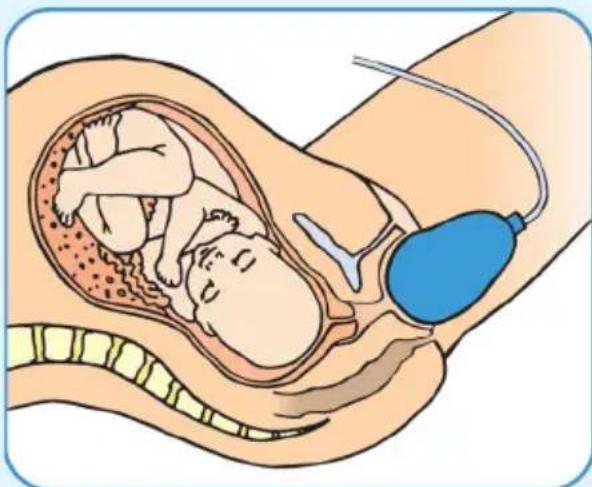 Epi-no Delphine Plus - In agli modo non dovete mai superare il Vostro personale livello di comfort. - 1