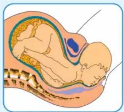 Epi-no Delphine Plus - Awertenze / Precauzioni - 2
