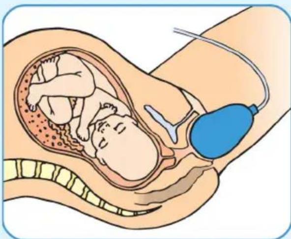 Epi-no Delphine Plus - Estirar el Periné - 1