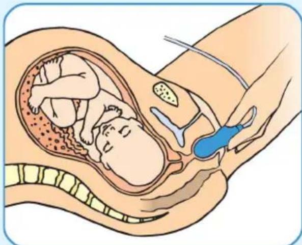 Epi-no Delphine Plus - Esercizi per il Pavimento Pelvico - 1
