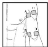 SANITAS SEM 43 - Electrode distance - 1