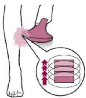 PHILIPS Lumea Advanced SC1998 - Dos发展模式 de tratamiento: "Paso y pulso" "deslizamente y pulso" - 2