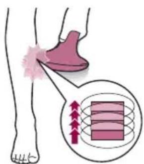 PHILIPS Lumea Advanced SC1998 - Zwei Behandlungsmodi: „Halten + Lichtimpuls" und „Gleiten + Lichtimpuls" - 2