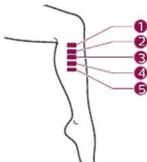 PHILIPS Lumea Advanced SC1998 - B Test skin 24 hours before treatment - 8