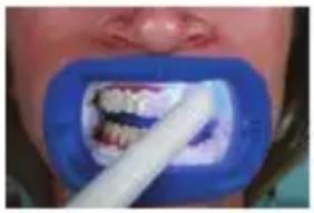 PHILIPS Zoom WhiteSpeed - In-office whitening treatment - 7