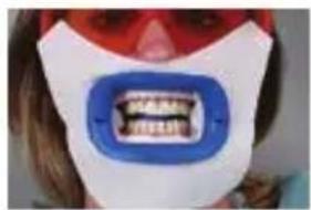 PHILIPS Zoom WhiteSpeed - In-office whitening treatment - 5